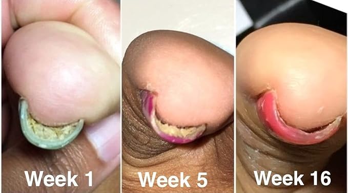 Probelle Natural Fungal Nail Oil, Nail Color Restoration, Clear Topical Solution .5 oz/ 15 ml