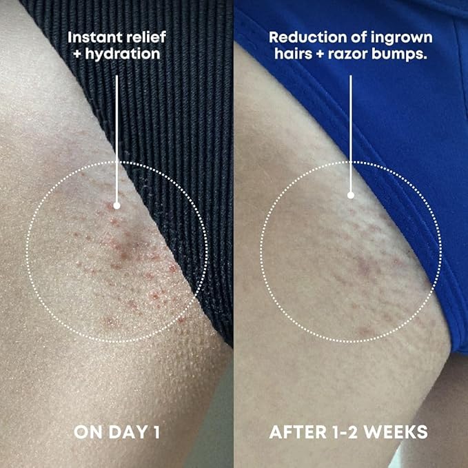 Bushbalm Ingrown Hair Exfoliating Scrub - Reduces Appearance of Ingrown Hairs and Razor Bumps, Soothes Skin and Post-Shave Redness - Watermelon Sugar, 236 ml