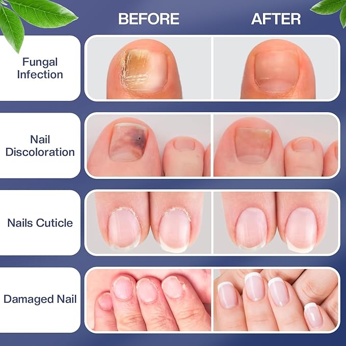 Toenail Treatment -Extra Strength Nail Treatment - Nail Repair Pen for Nail Discoloration Nails - 4PCS