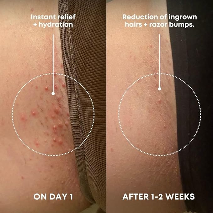 Bushbalm Ingrown Hair Exfoliating Scrub - Reduces Appearance of Ingrown Hairs and Razor Bumps, Soothes Skin and Post-Shave Redness - Watermelon Sugar, 236 ml