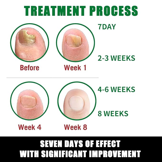 Ginger Nail Treatment Nail Support Nail Care, 7Days Nail Treatment Serum, Multi-Purpose Nail Repair