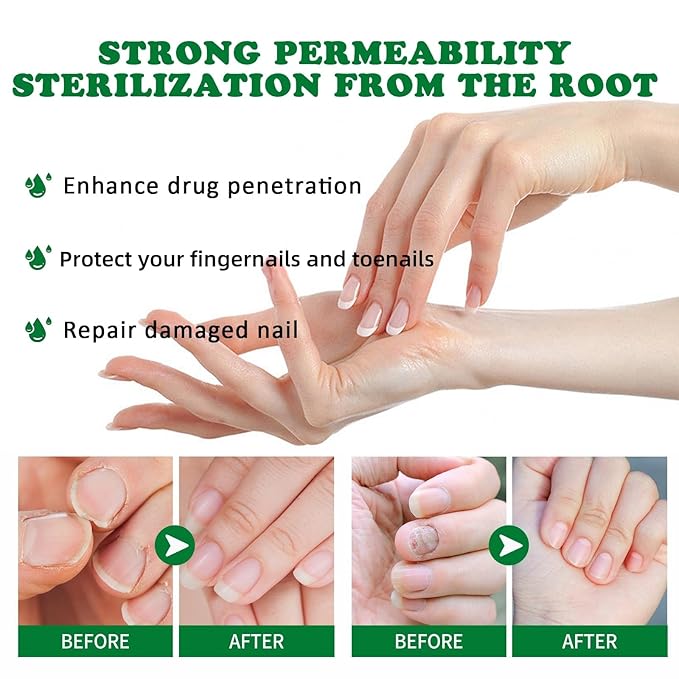 Ginger Nail Treatment Nail Support Nail Care, 7Days Nail Treatment Serum, Multi-Purpose Nail Repair