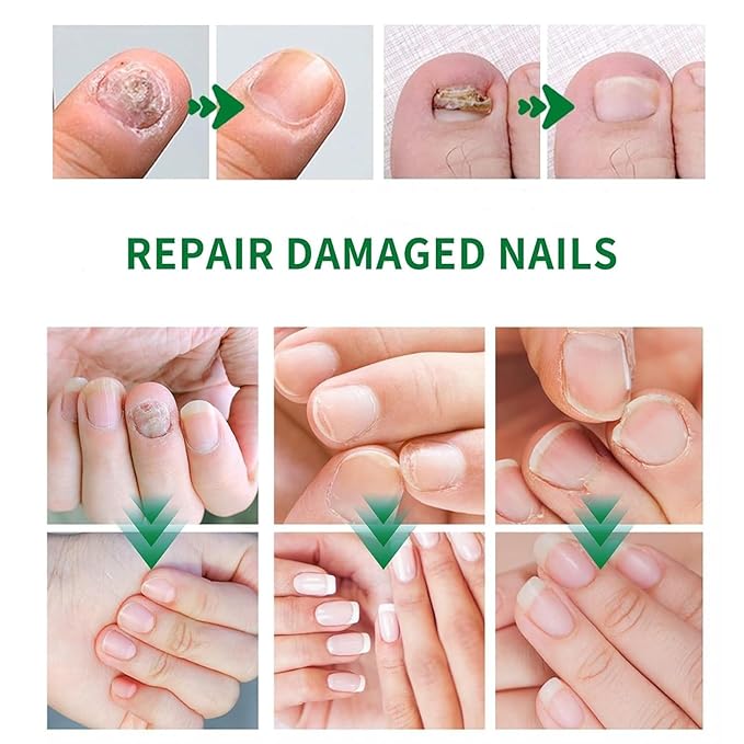 7 days Nail Growth Serum, 2PCS 7 Days Ginger Nail Essence, Multi-Purpose Nail Repair, Nail Nutrient Oil Strengthener Oil (2pcs)