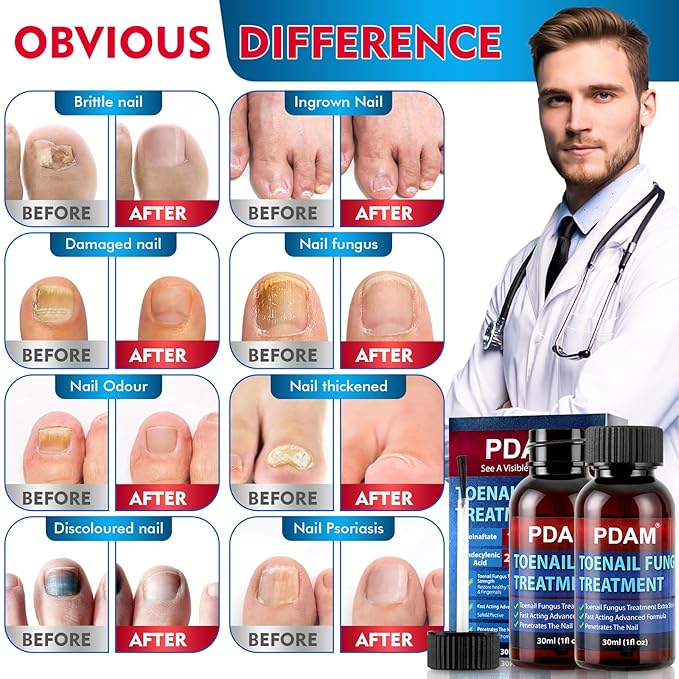 Toenail Fungus Treatment Extra Strength - Toe Nail Fungus Treatments for Thick, Nail Strengthener and Growth, Nail Fungus Treatment Extra Strength for Broken, Discolored Nail & Ingrown Toenail - 60ml