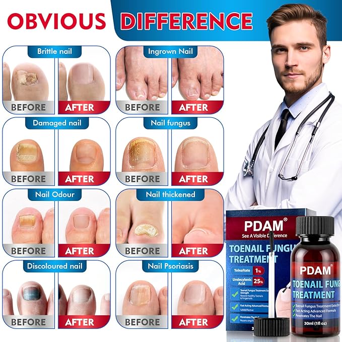 Toenail Fungus Treatment Extra Strength - Toe Nail Fungus Treatments for Thick, Nail Strengthener and Growth, Nail Fungus Treatment Extra Strength for Broken, Discolored Nail & Ingrown Toenail - 30ml