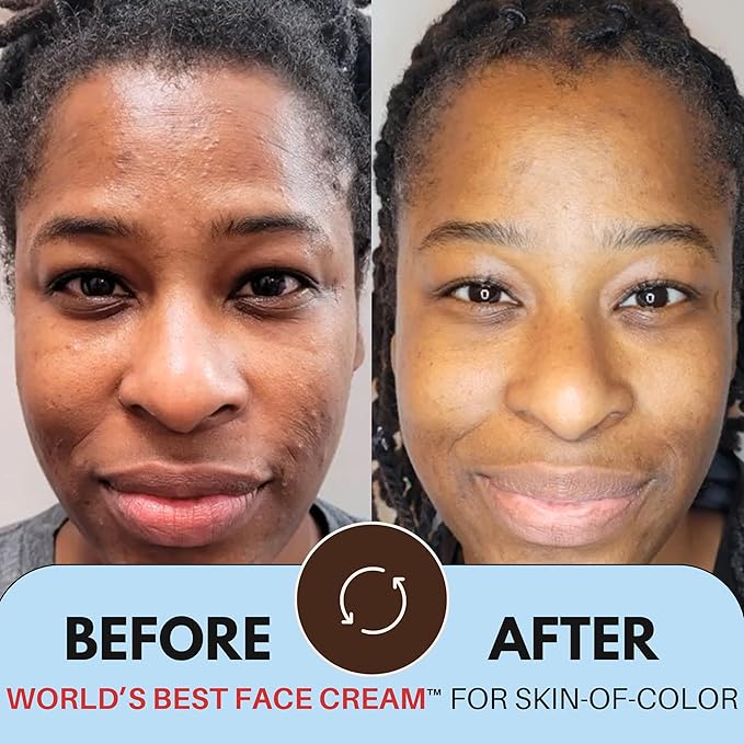 World’s Best Face Cream™ for Skin-of-Color, Anti Aging Reverse Signs of Aging Hydrates Niacinamide Squalane Hyaluronic Acid, 2 oz