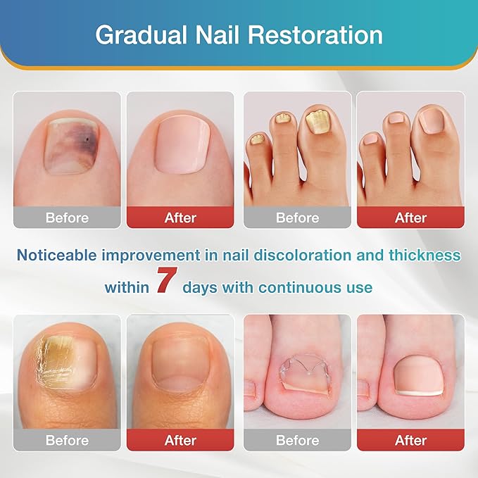 Toenail Fungus Treatment Extra Strength - 20 Hydrogel Patches for Overnight Nail Repair, 8-Hour Nighttime Fungal Nail Patches, Restores Healthy Appearance, Waterproof & Painless Relief