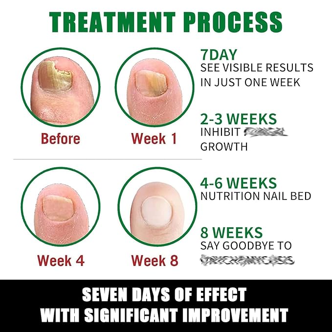 Ginger Nail Growth Serum, 7 Days Nail Treatment, Ginger Nail Treatment, Ginger Cuticle Care Oil for Strengthen & Promote Nail Growth (2Pcs)