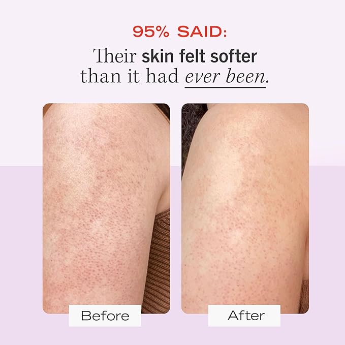 First Aid Beauty - KP Bump Eraser Body Scrub with 10% AHA, Keratosis Pilaris Skin Exfoliater with Glycolic and Lactic acids, Helps Reduce Chicken Skin Bumps, Safe for Sensitive Skin, 8 oz, 2ct