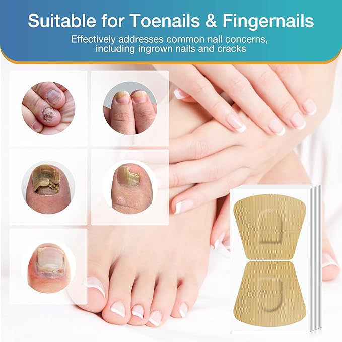 Toenail Fungus Treatment Extra Strength - 20 Hydrogel Patches for Overnight Nail Repair, 8-Hour Nighttime Fungal Nail Patches, Restores Healthy Appearance, Waterproof & Painless Relief